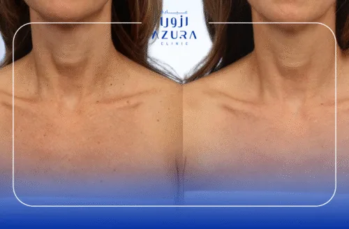 Neck Rejuvenation with Carbon Laser