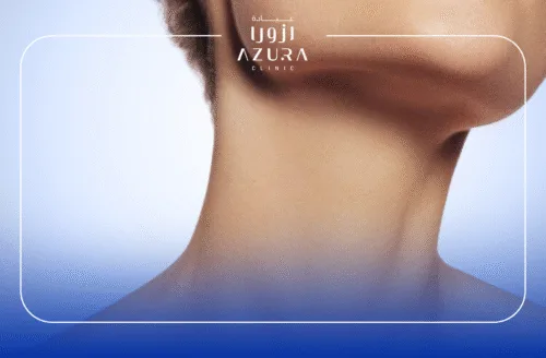 Neck Thread Lift
