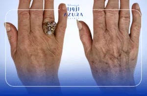 RF Fractional for Hands