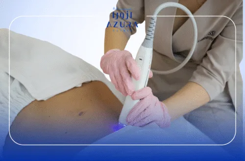 RF Fractional for Stretch Marks