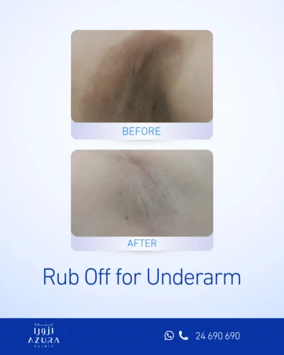 Rub Off treatment for underarm pigmentation at Azura Clinic in Muscat, Oman