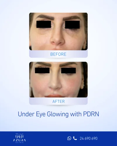 Before and after PDRN under-eye treatment at Azura Clinic Muscat, showing a brighter and more refreshed appearance around the eyes.