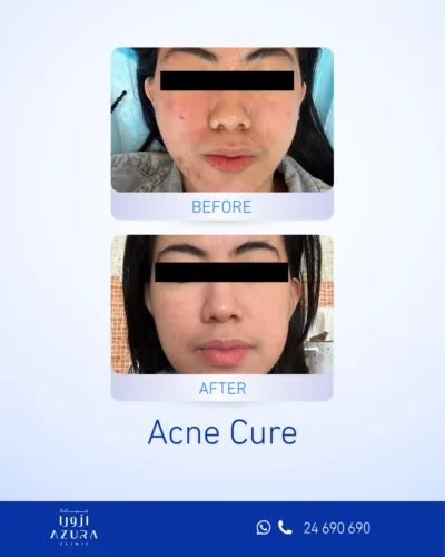 Acne Cure treatment before and after facial skin results at Azura Clinic