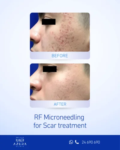 Before and after RF microneedling scar treatment on the cheek, reduced acne scars and smoother skin texture at Azura Clinic Muscat