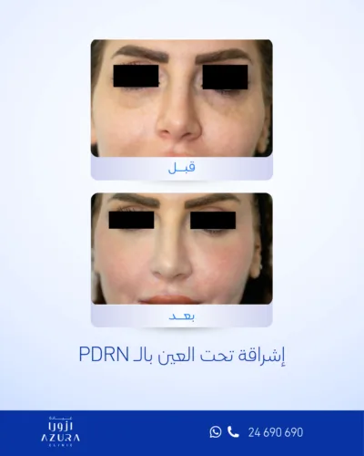 علاج إشراقة تحت العين مع PDRN في عيادة أزورا بمسقط لدعم الترطيب وتحسين مظهر منطقة تحت العين.