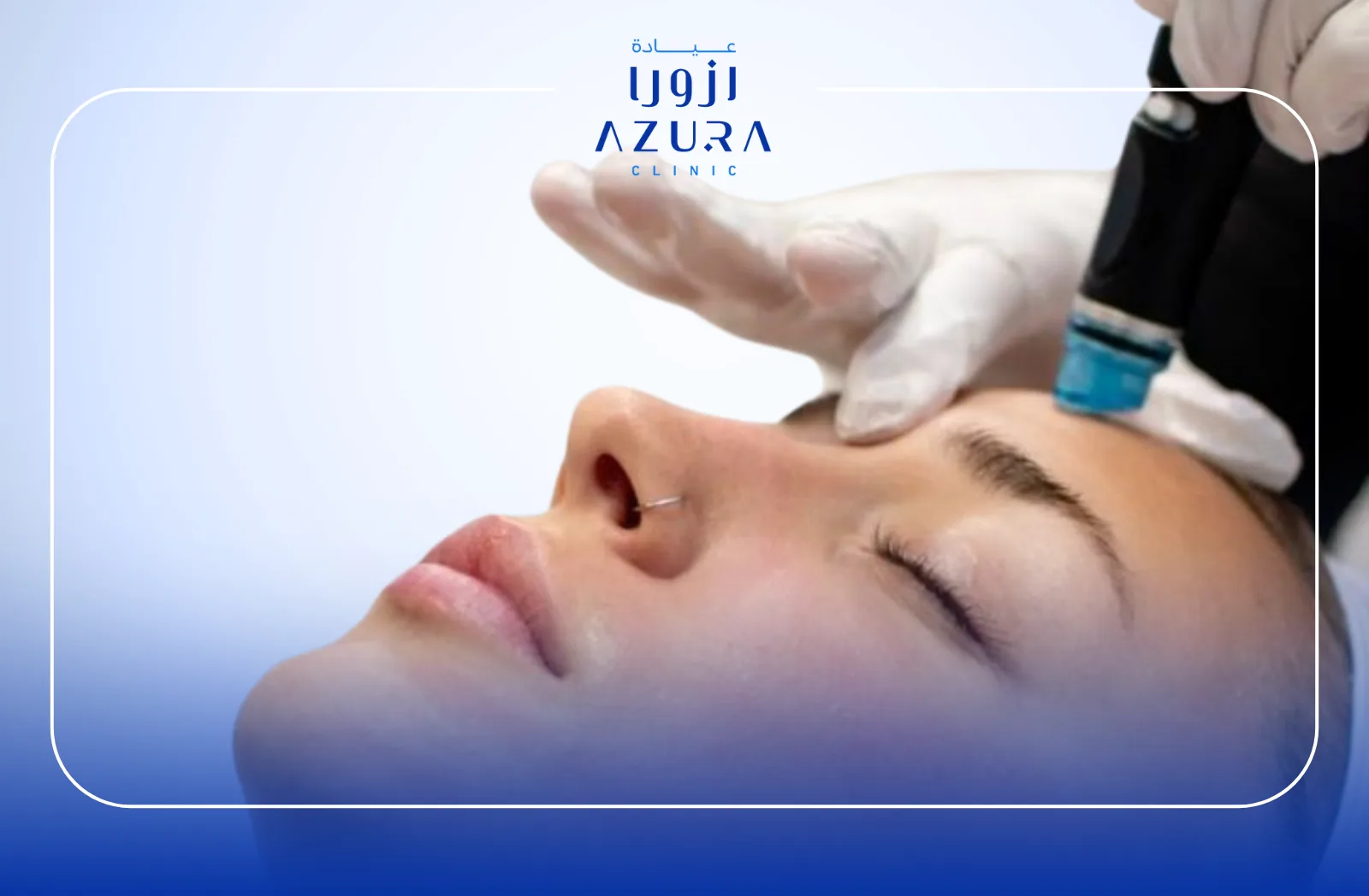 6 Stunning Benefits of RF Vivace + Profund for Radiant, Youthful Skin