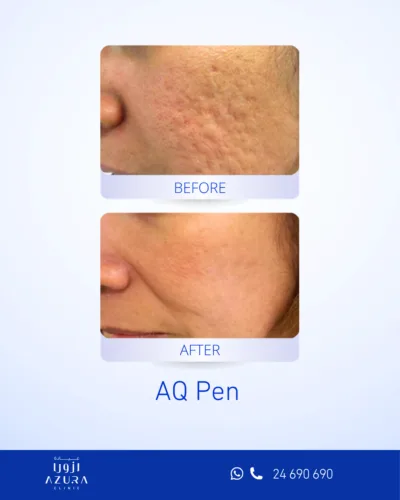 Before and after acne scar treatment on the cheek with AQ Pen at Azura Clinic Muscat