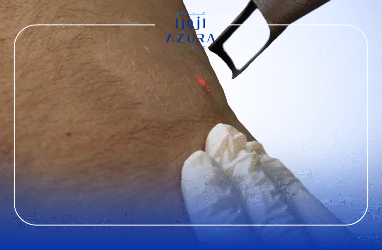 Q-Switched laser bleaching fine dark facial hair on female cheek at Azura Clinic Muscat