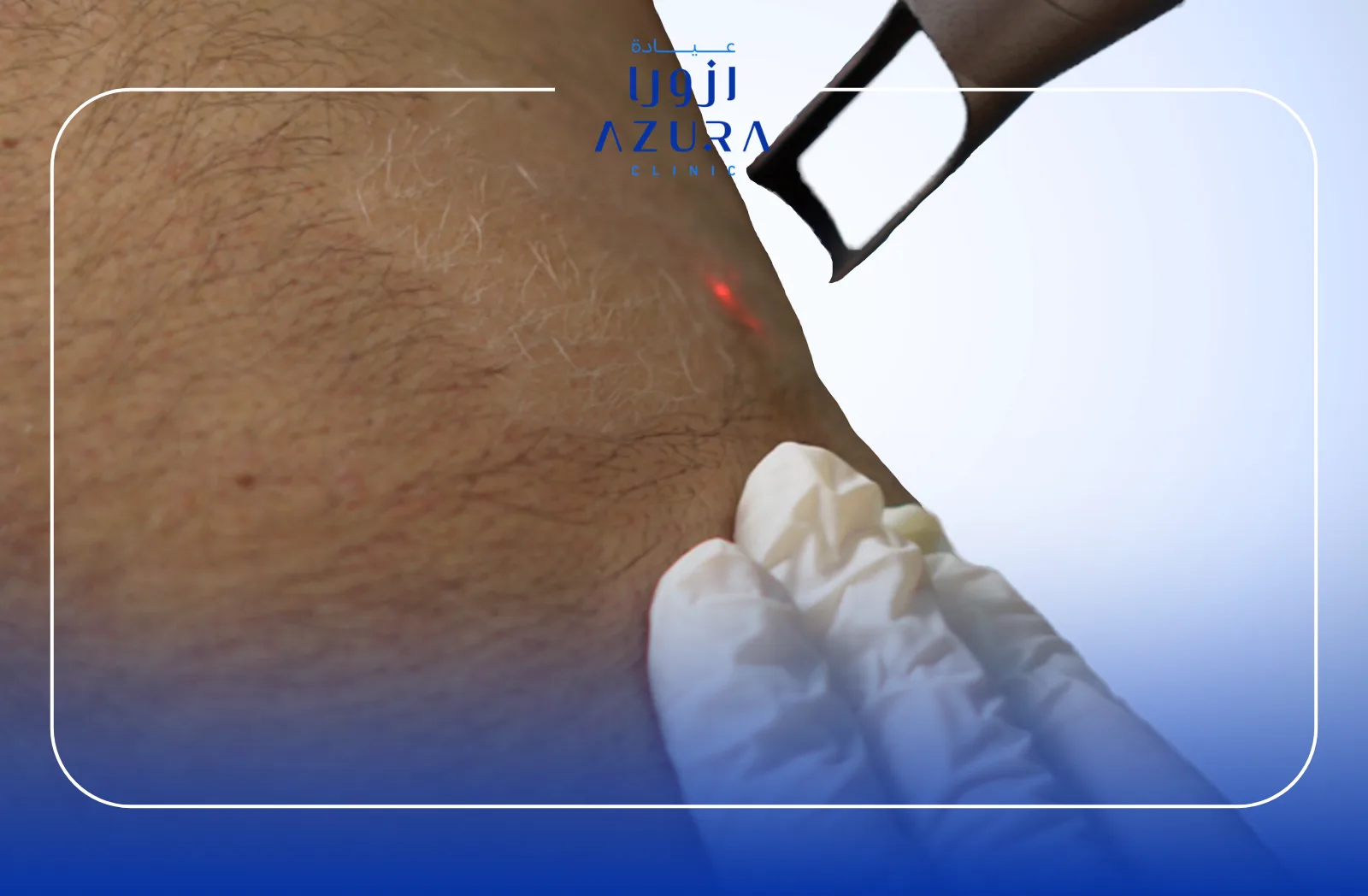 Hair Bleaching with Q-Switched Laser: 5 Powerful Benefits for Safe and Effective Hair Lightening