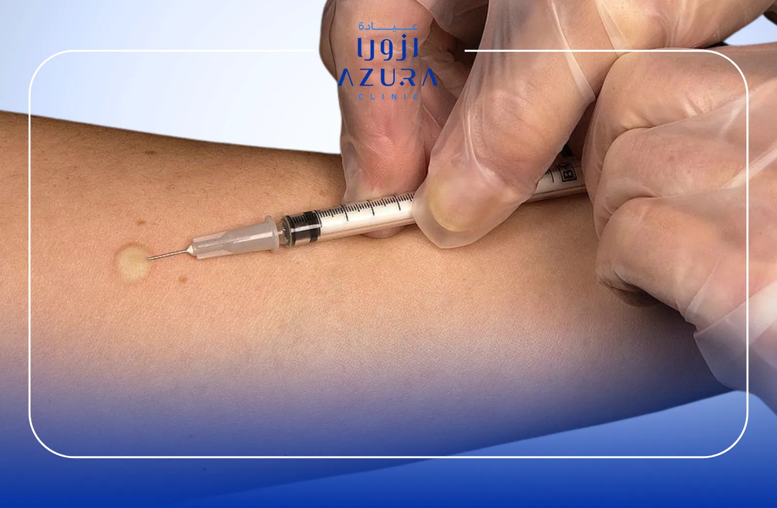 Intradermal Injection