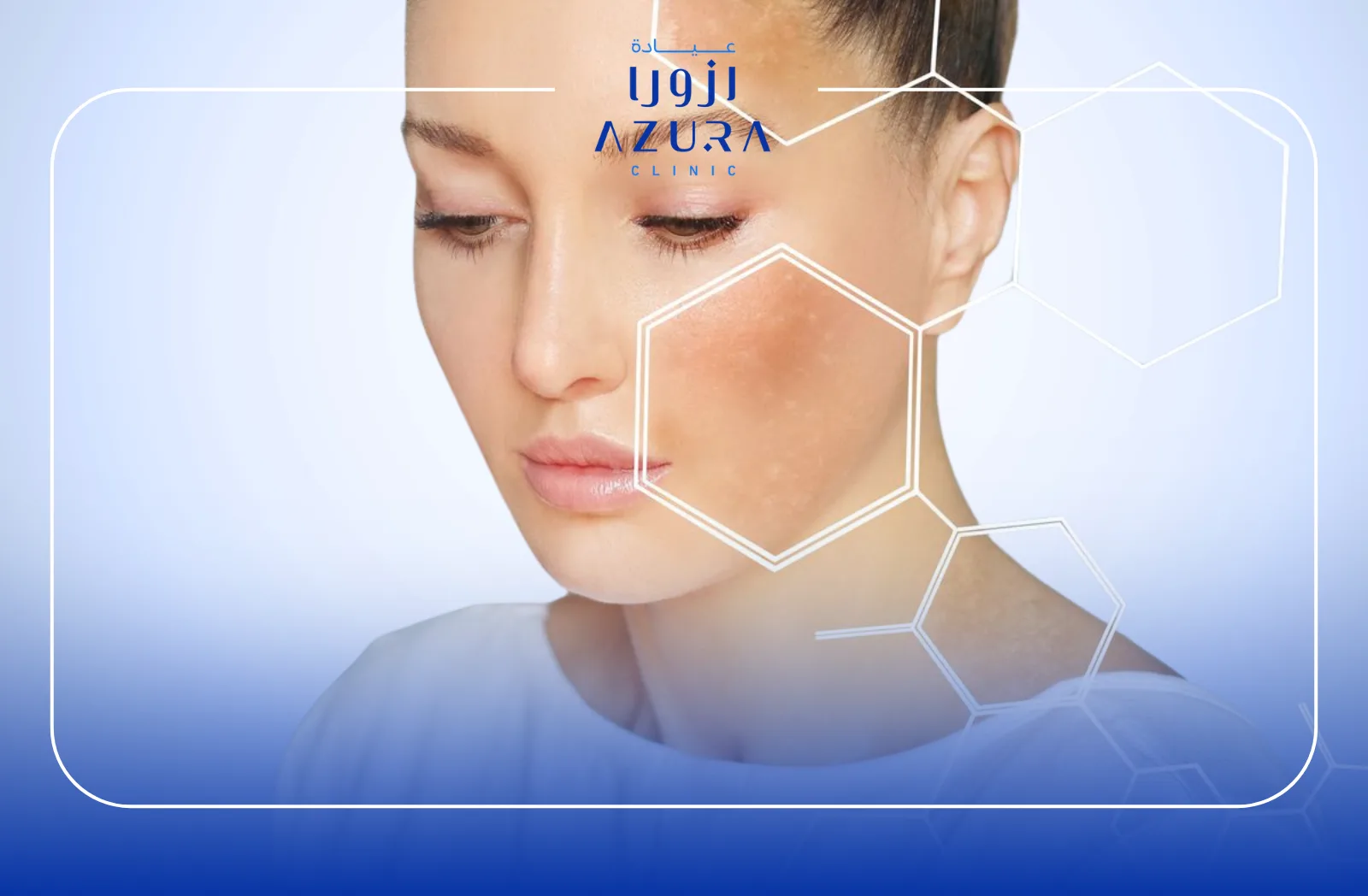 Melasma
