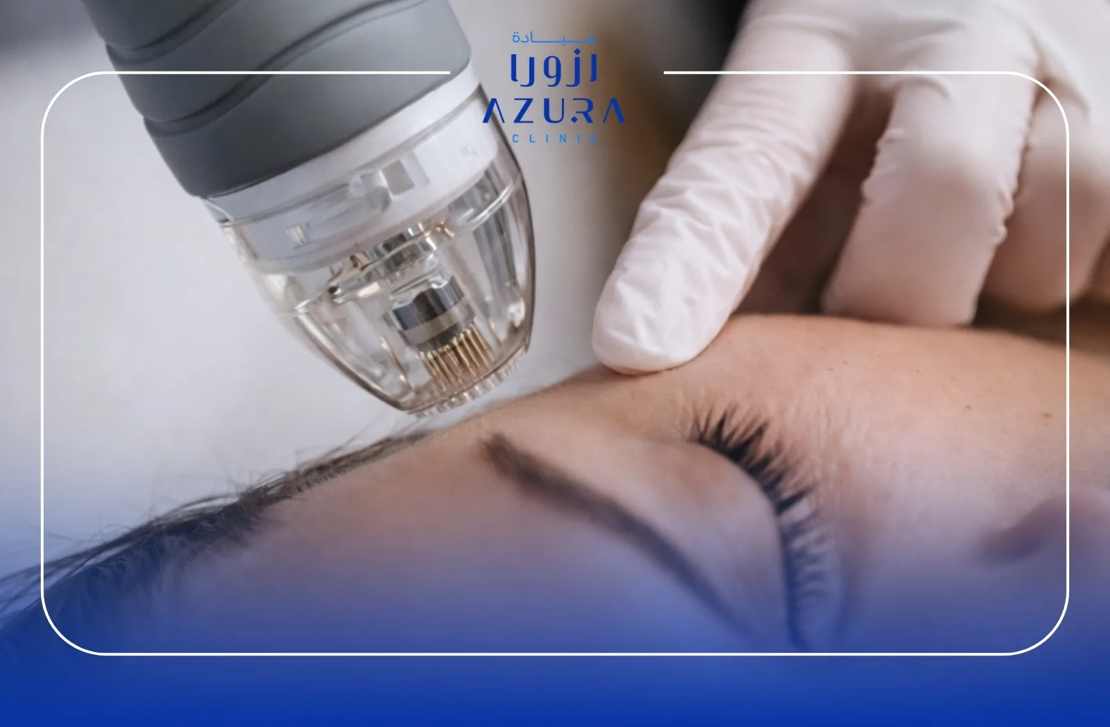 RF Vivace and Exosome skin rejuvenation treatment at Azura Clinic Muscat