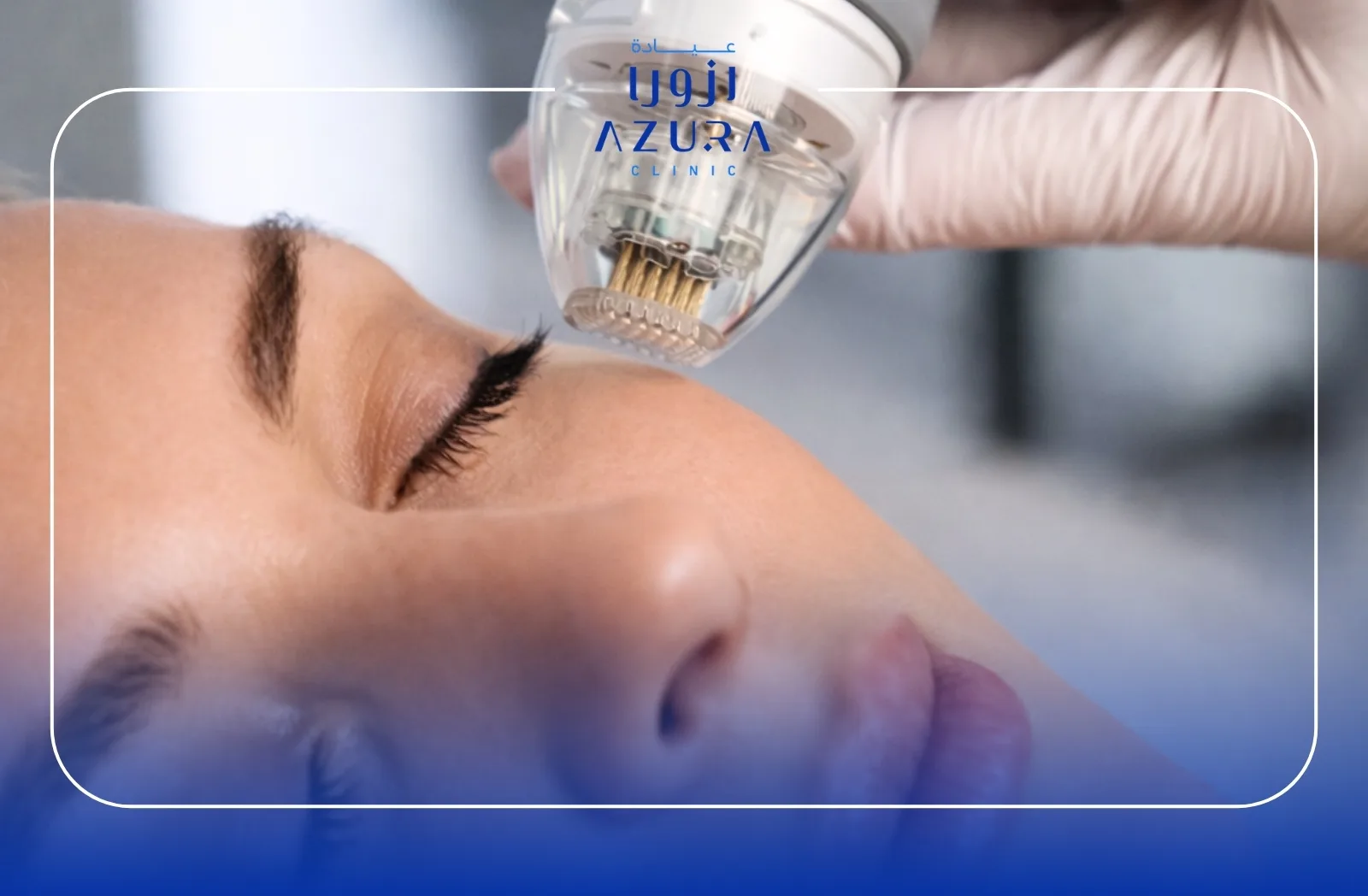 RF Vivace and Vitamin therapy skin rejuvenation treatment at Azura Clinic Muscat