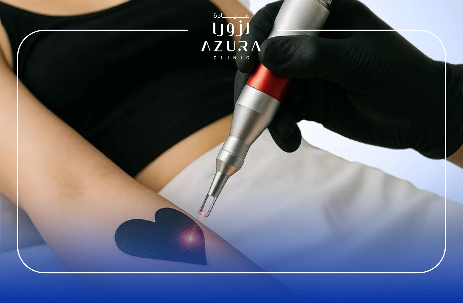 Tattoo Removal (Q-Switched Laser)