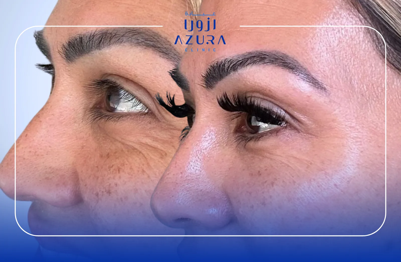 Under Eye Brightening