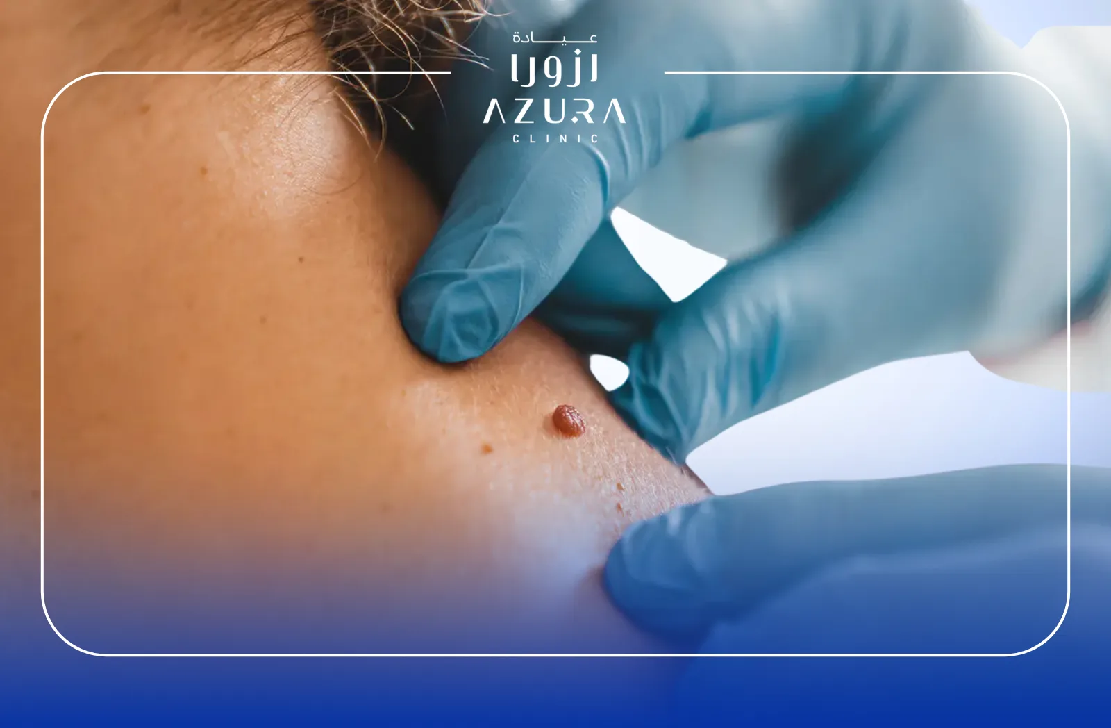 Wart,Skin Tag,Mole Removal