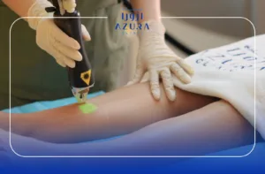 Laser Hair Removal for Women
