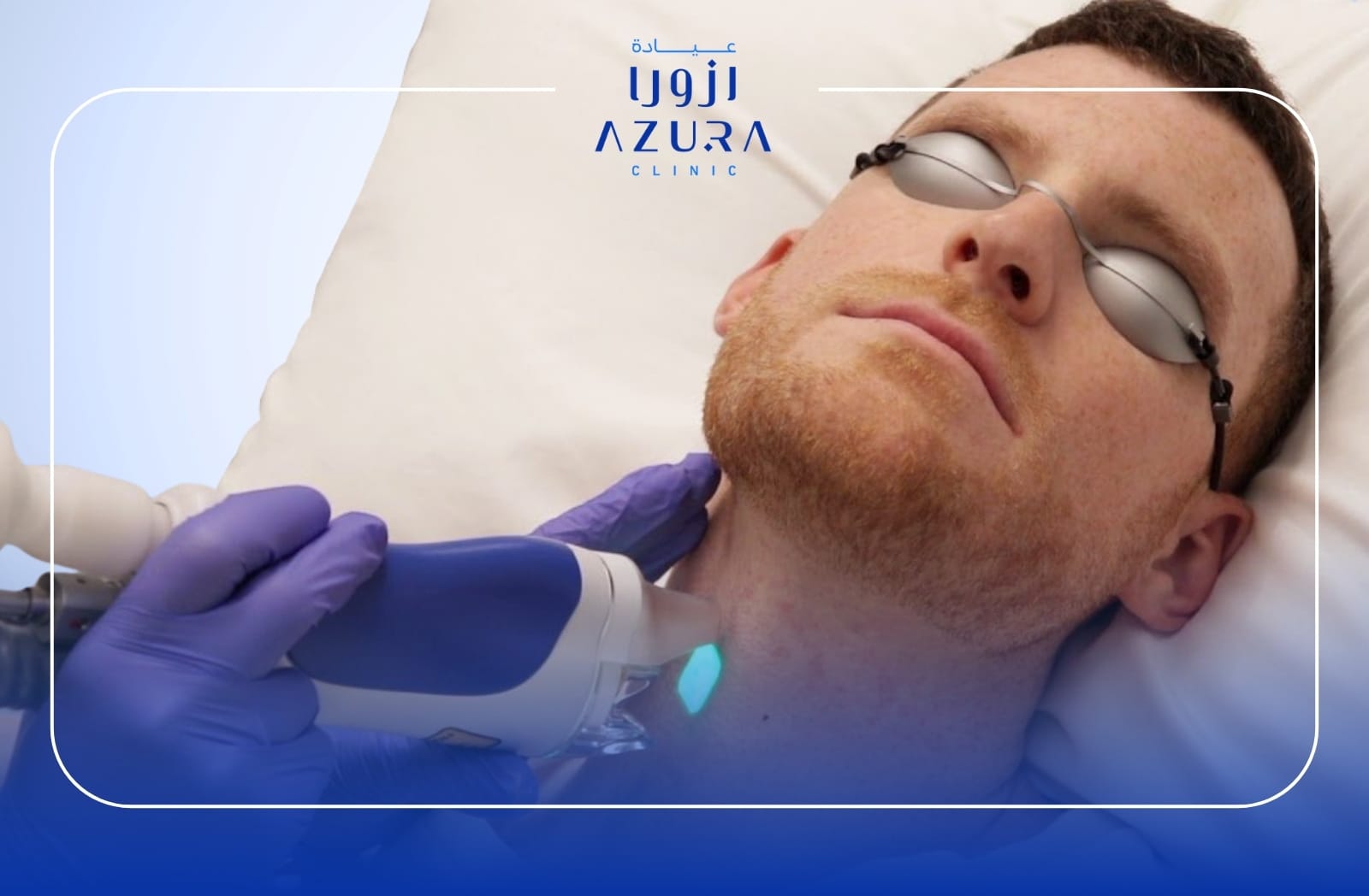 Laser Hair Removal for Men
