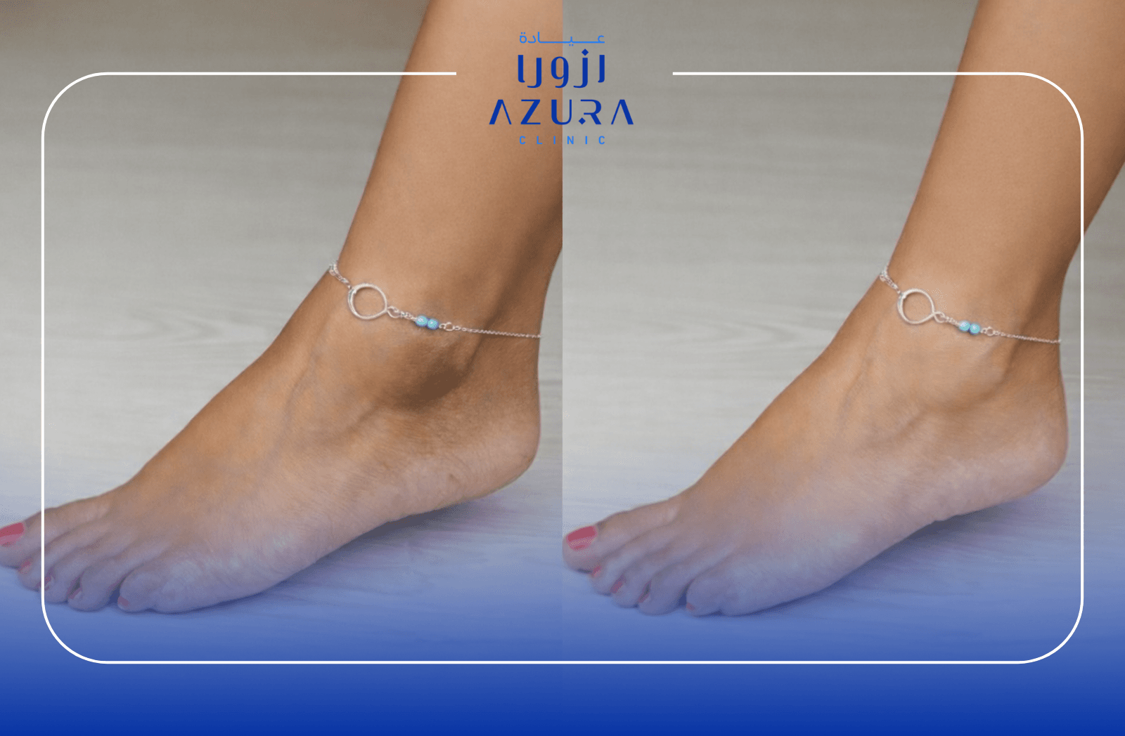 Rub Off for Ankle