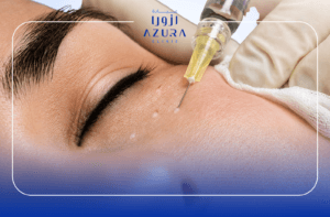Meso Eye Glow under-eye treatment at Azura Clinic Muscat