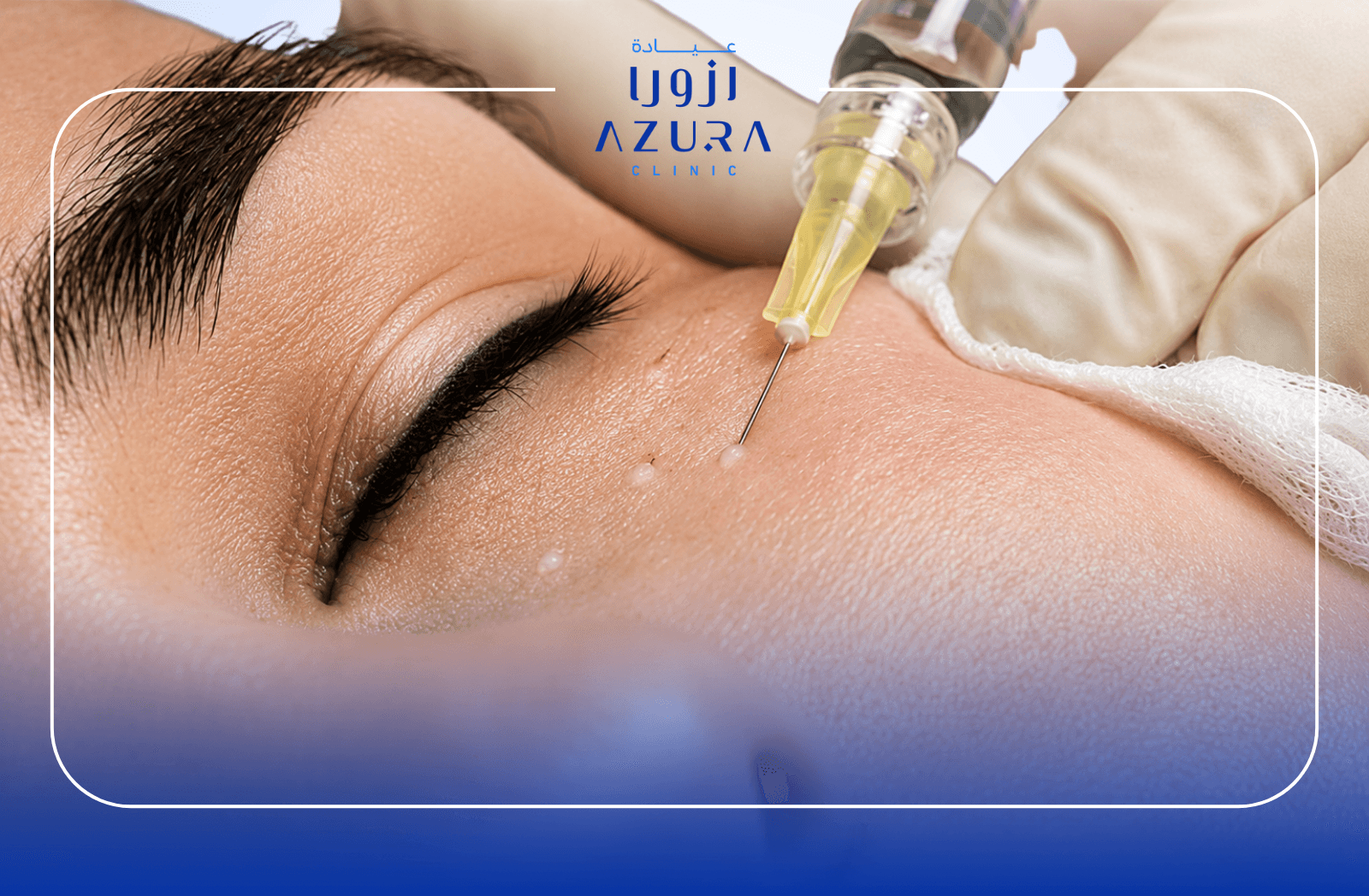 Meso Eye Glow under-eye treatment at Azura Clinic Muscat