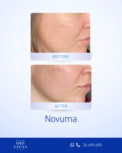 Before and after Novuma treatment on the cheeks showing reduced active breakouts and smoother skin texture at Azura Clinic Muscat