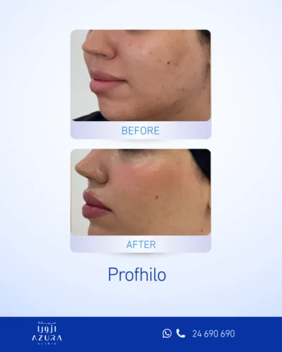 Before and after results of Profhilo skin treatment at Azura Clinic Muscat