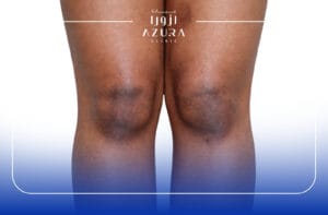 Rub Off for Knee