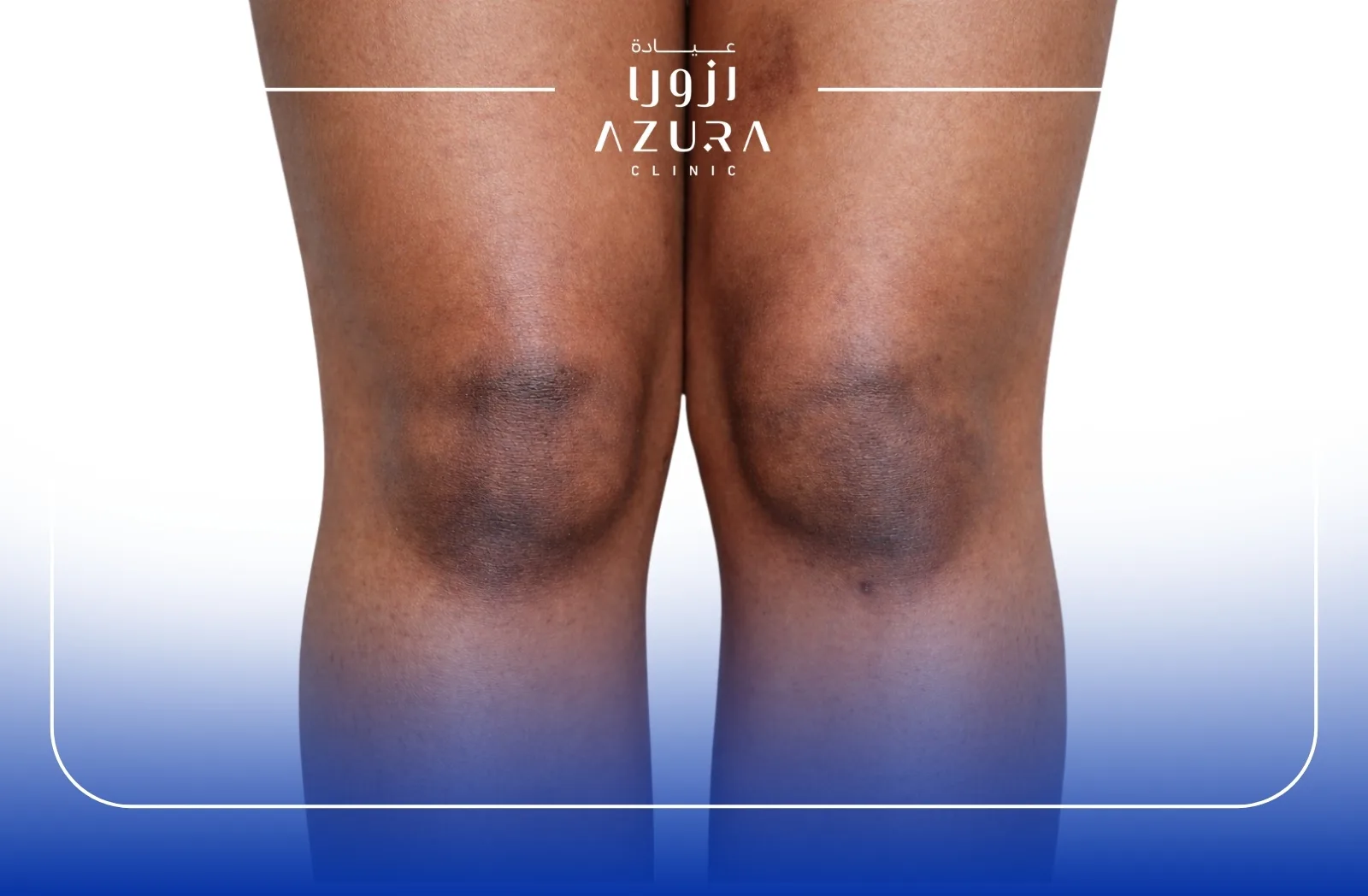 Rub off for knee brightening treatment at Azura Clinic Muscat