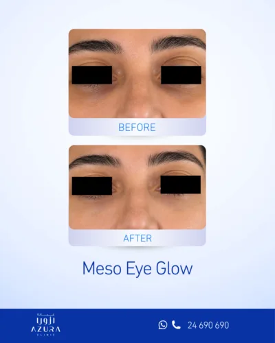 Meso Eye Glow before and after under-eye treatment results at Azura Clinic