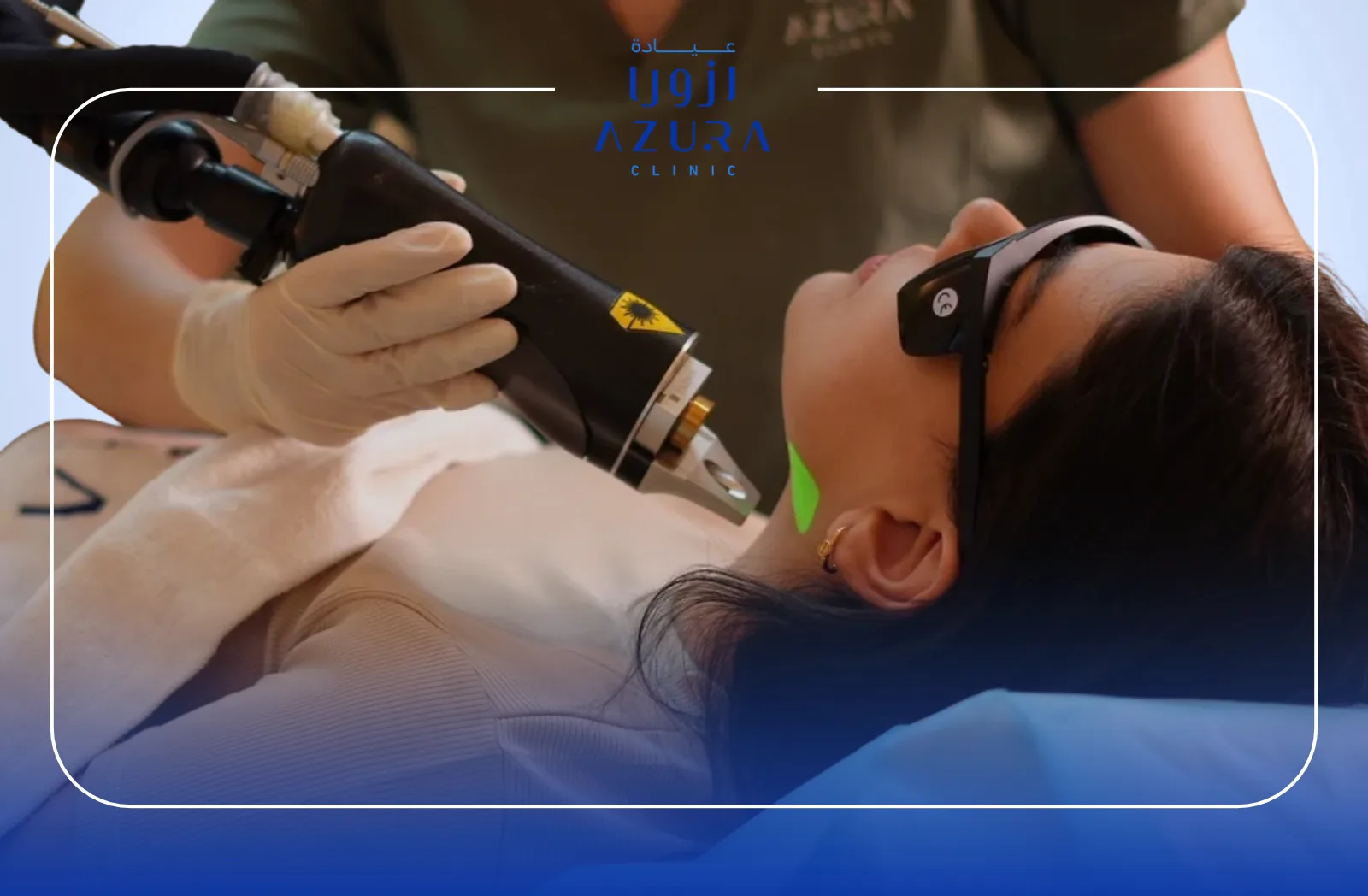 Face laser hair removal treatment at Azura Clinic Muscat using Splendor X