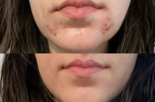 Dermatologist examining facial acne and skin texture during an acne consultation in Muscat, Oman